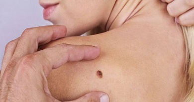 lunares - cáncer de piel